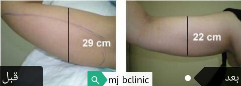 شد الذراع 768x275