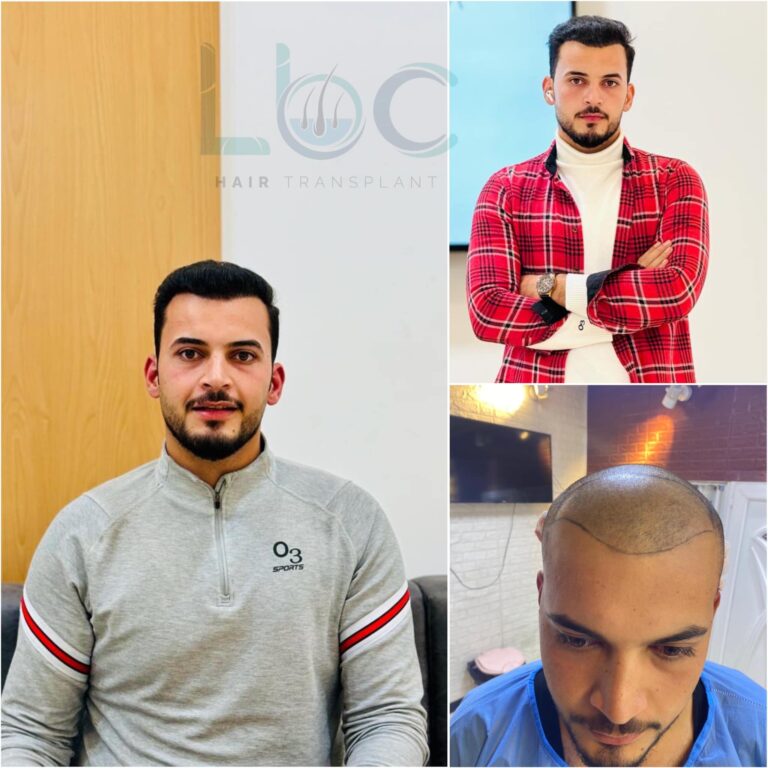 شعر زراعة 2 768x768