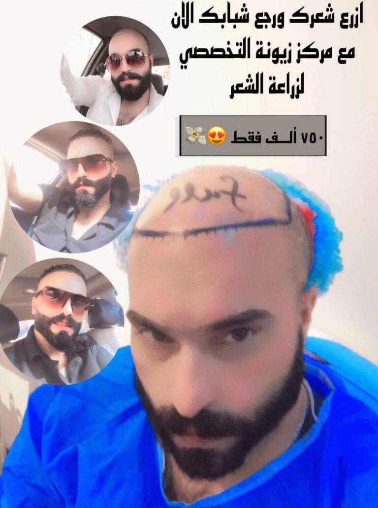 شعر زراعة 3 768x1030