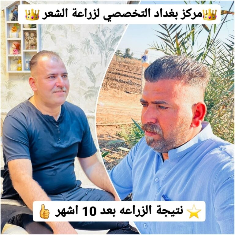 شعر زراعة 768x768