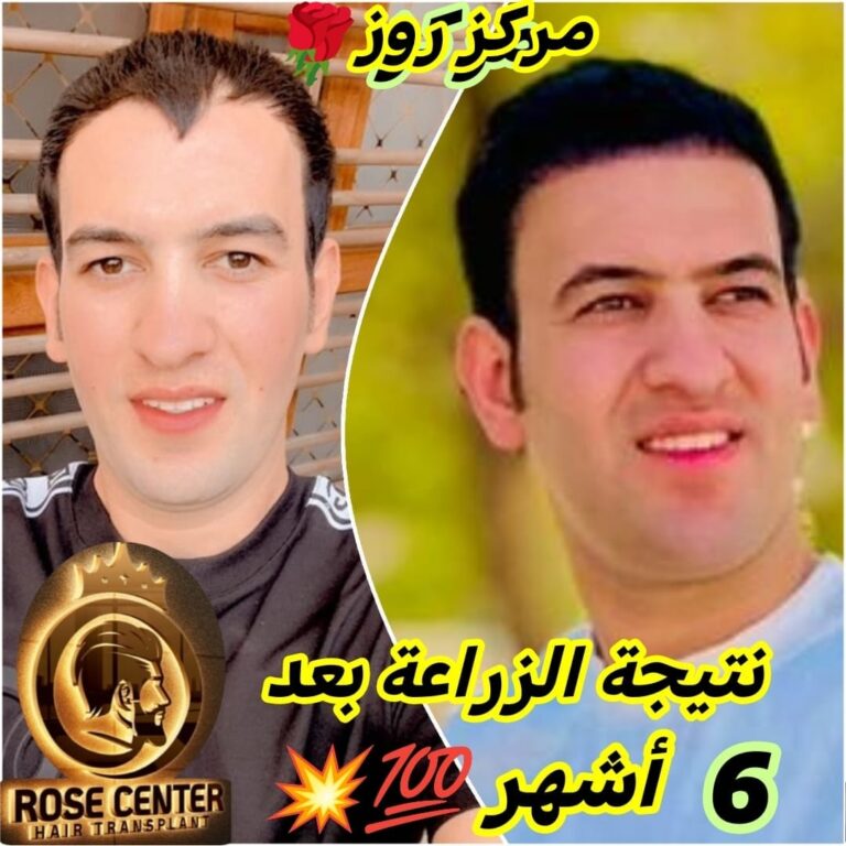 شعر زراعه 768x768