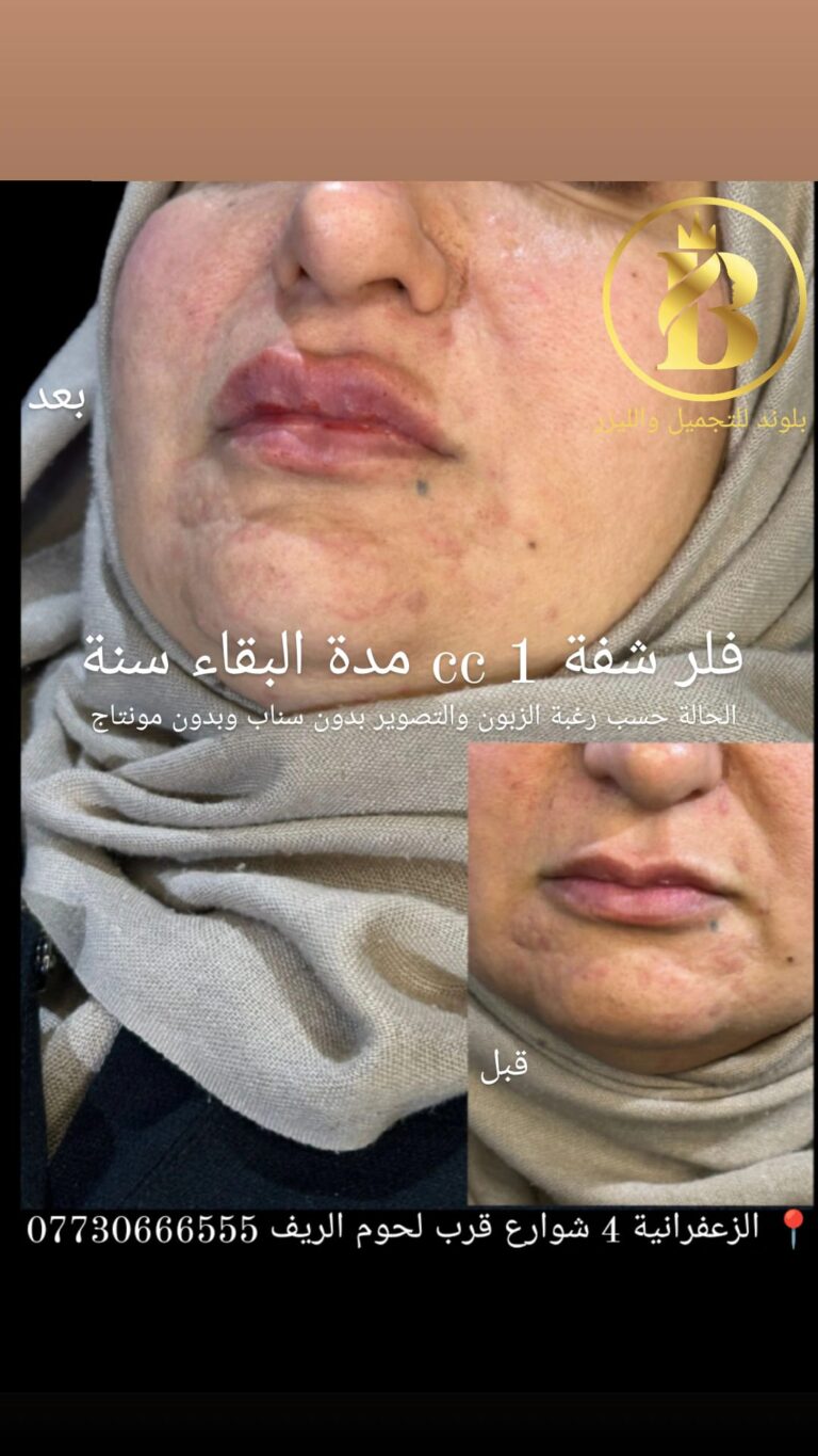 شفاه فبر 768x1365