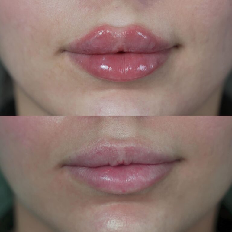 شفاه فلر 768x768