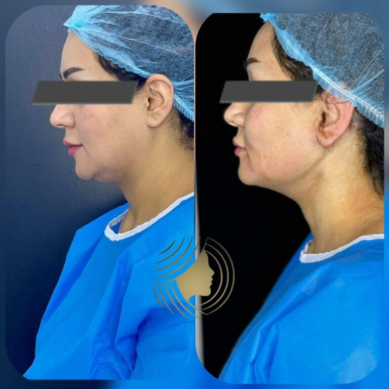 شفط الدهون 768x768