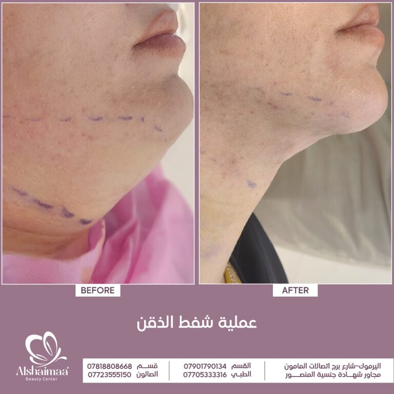 شفط الذقن 1 768x768