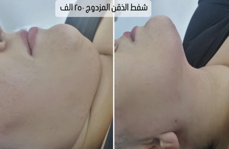 شفط الذقن المزدوج 1 768x501