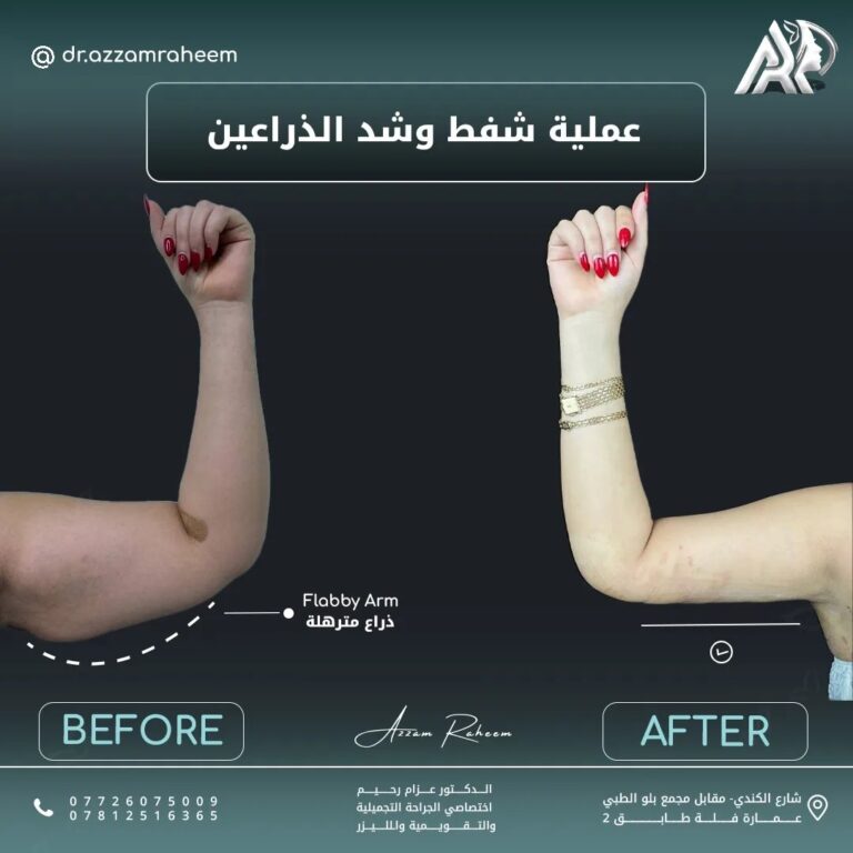 شفط دهون الذراع 768x768
