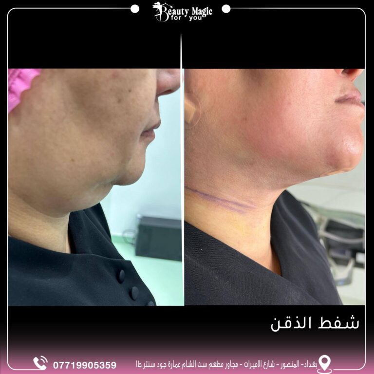 شفط ذقن 768x768