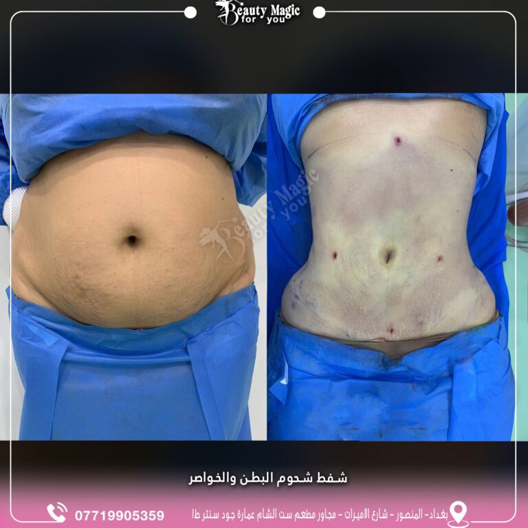 شفط شحوم البطن مع الخواصر 768x768