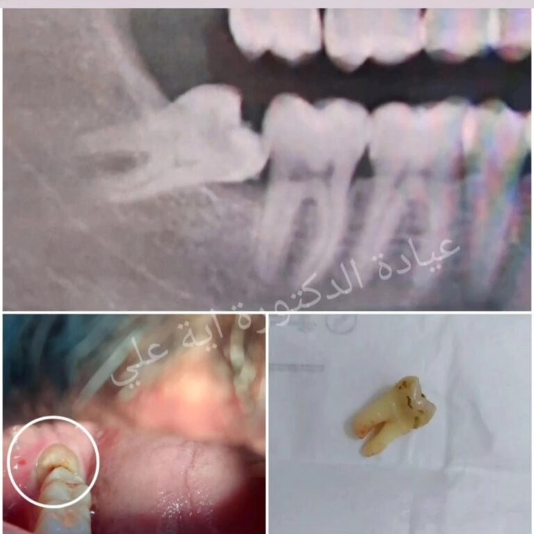 شلع سن العقل 768x768