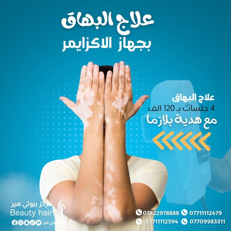 علاج البهاق 768x770