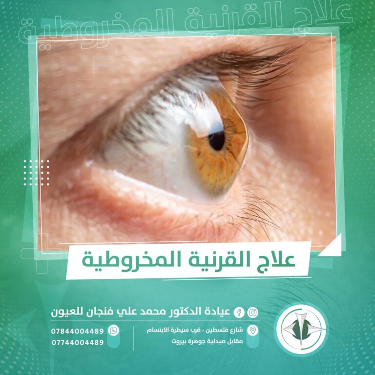 علاج القرنيه المخروطيه 768x768