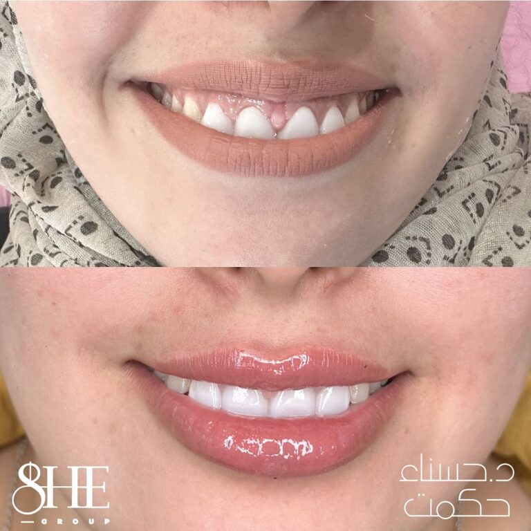 علاج اللثويه 768x768