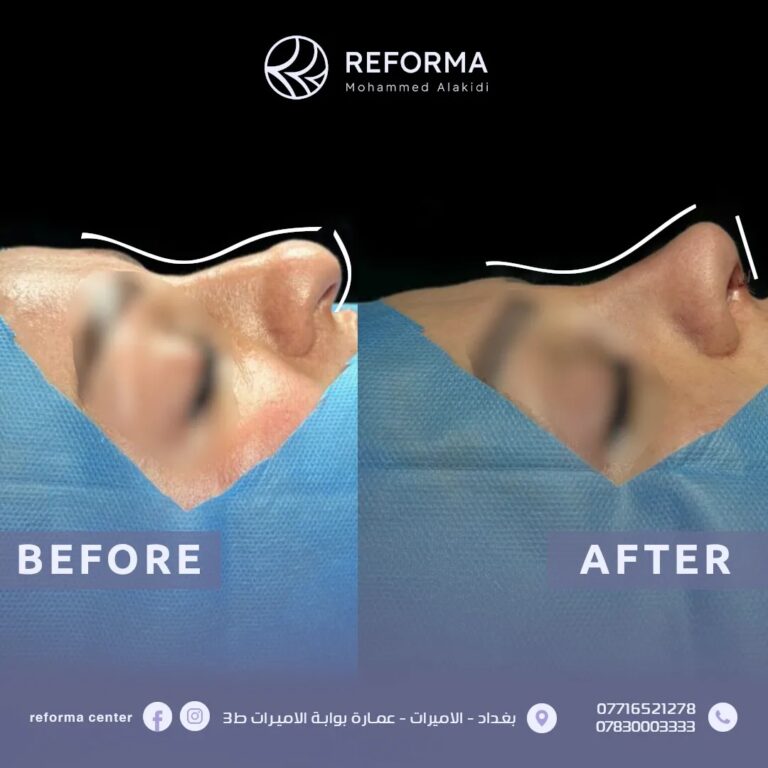 عملية الانف 768x768