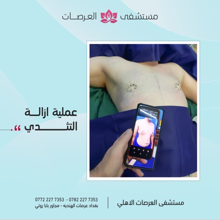 عمليه ازالة ثدي 768x768