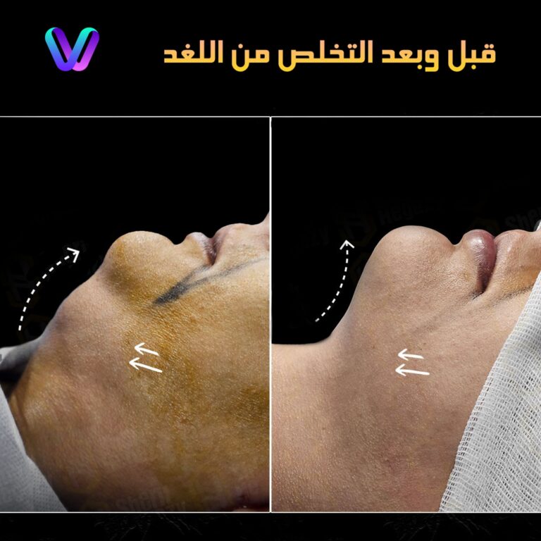 عمليه اللغد 768x768