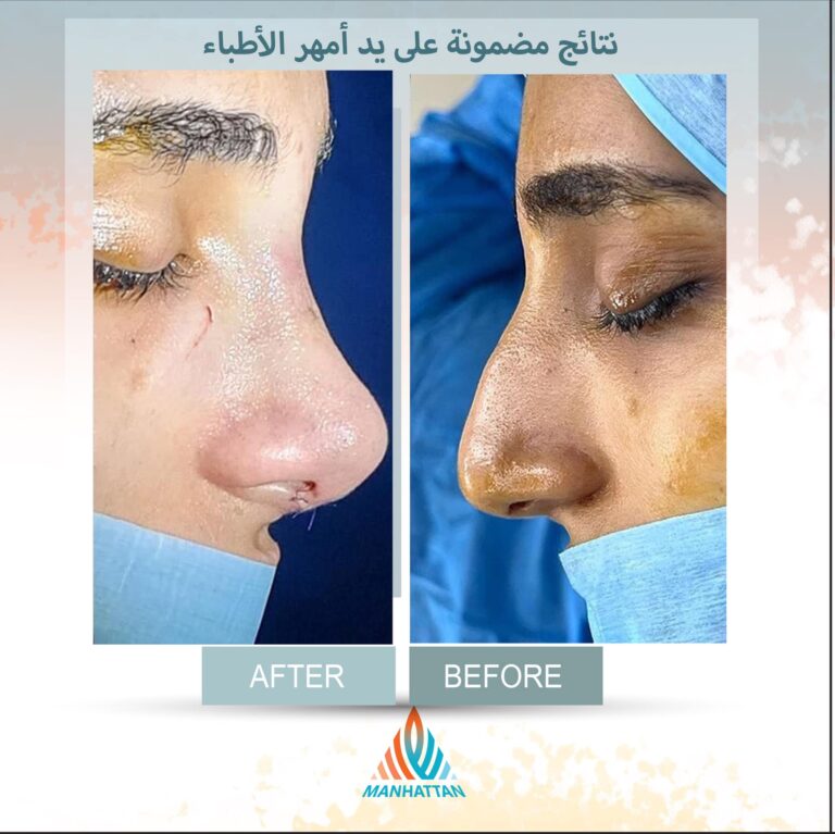 عمليه انف 1 768x767