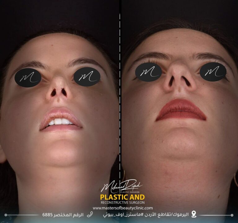 عمليه انف 768x720