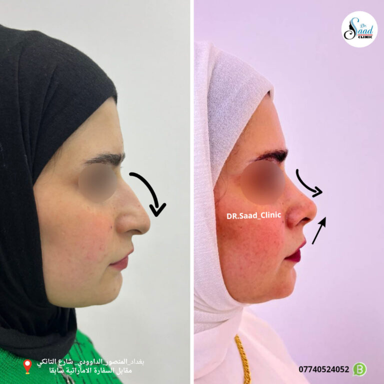 عمليه رفع الانف 768x768