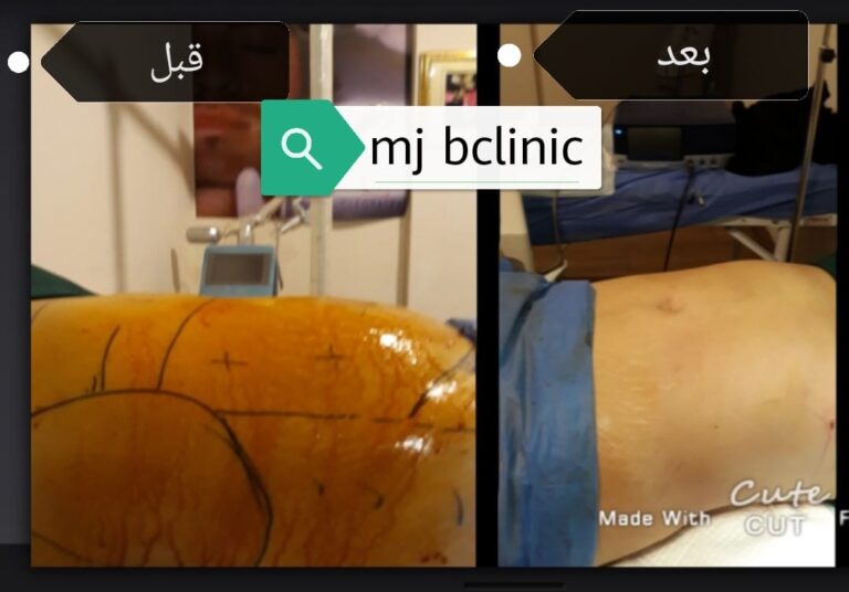 عمليه شفط الدهون 768x536