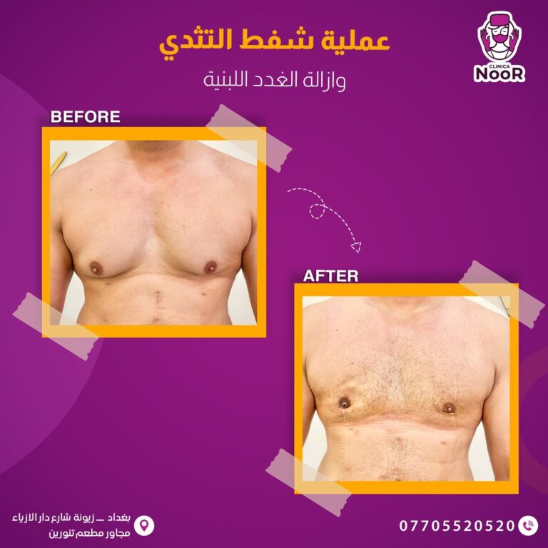 عمليه شفط دهون الثدي 768x768