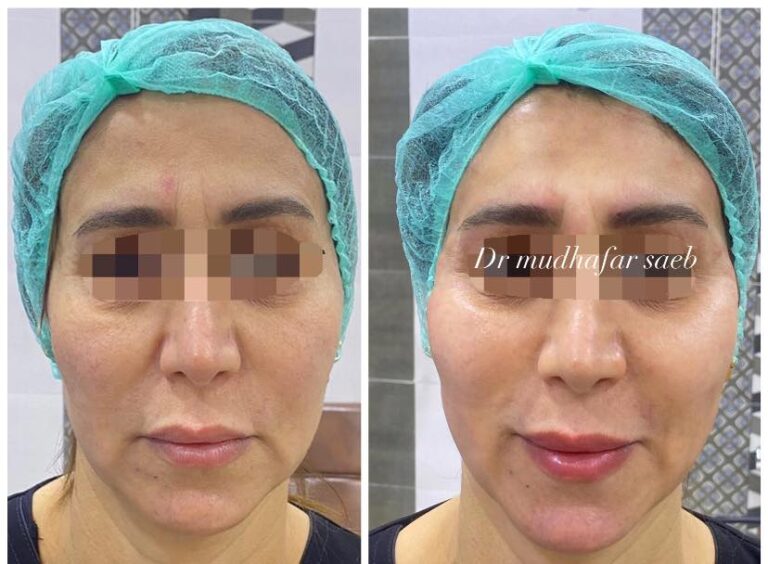 فلر المنطقه الصدعيه 768x564