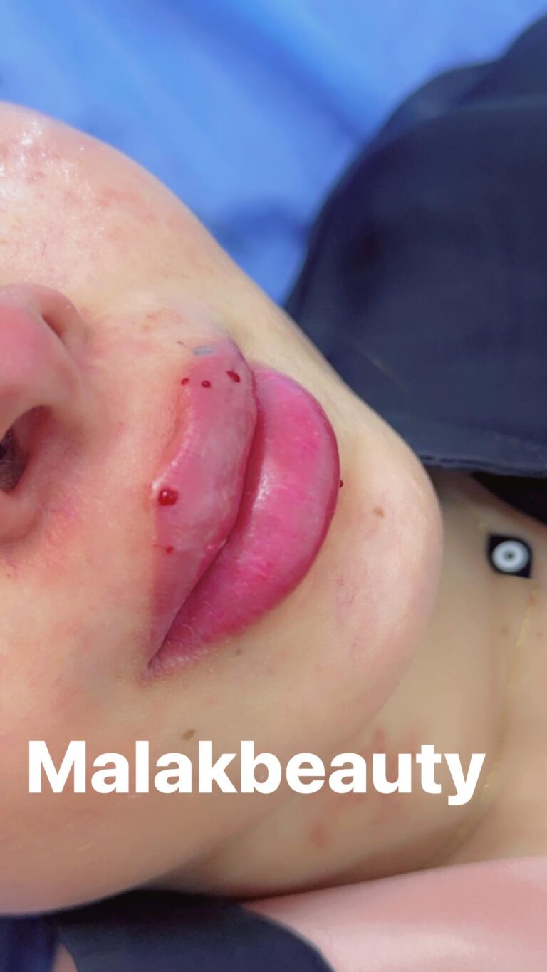 فلر شفاة 1 768x1364