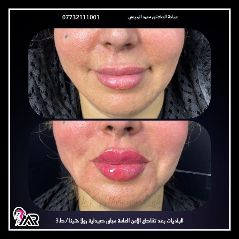 فلر شفاة 768x768