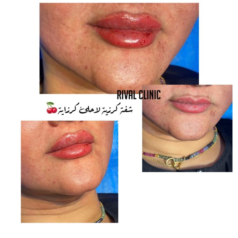 فلر شفاه 1 1 768x768