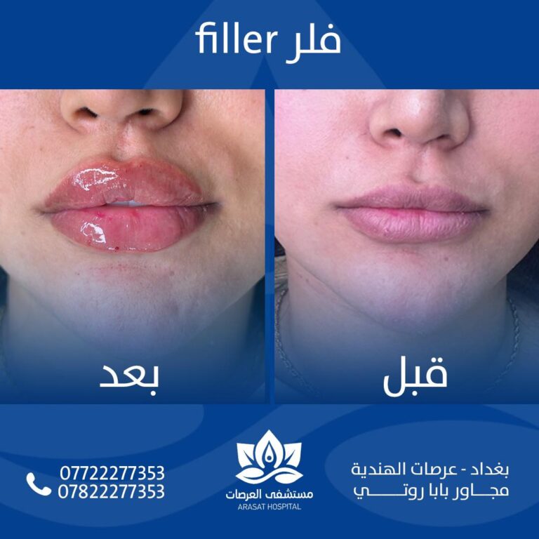 فلر شفاه 1 768x768