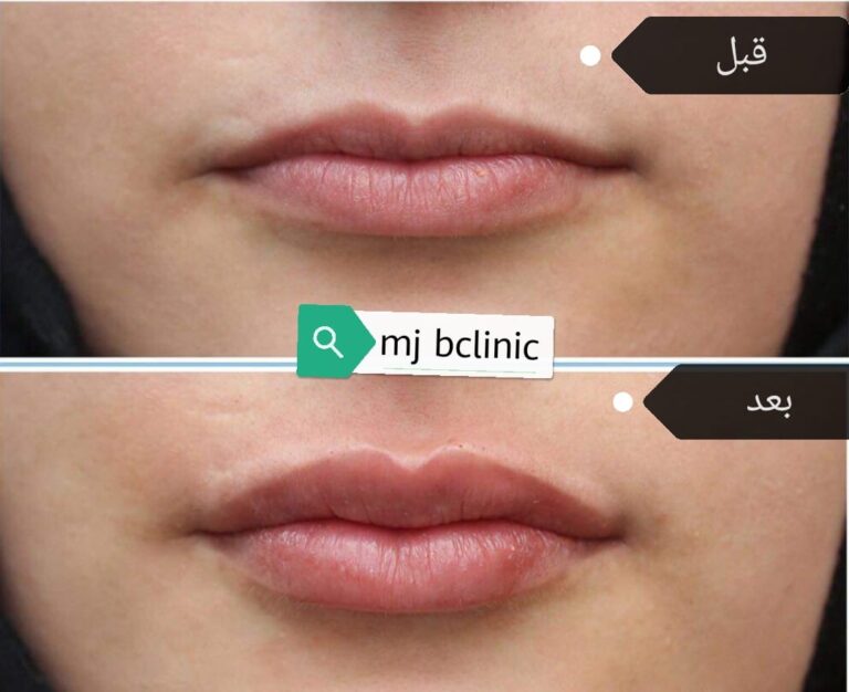 فلر شفاه 16 768x626