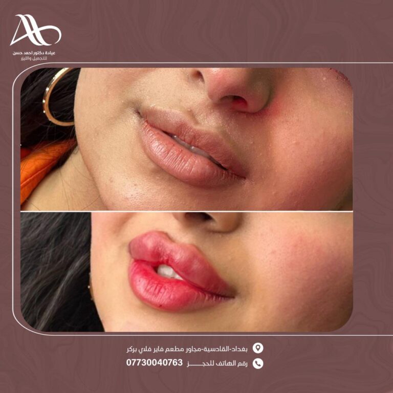 فلر شفاه 17 768x768