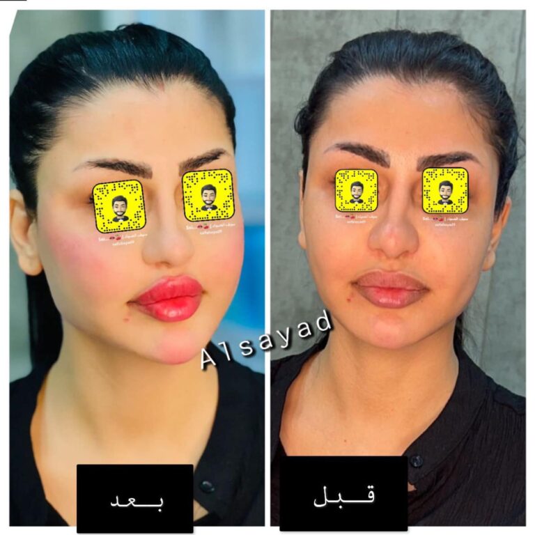 فلر شفاه 18 768x768