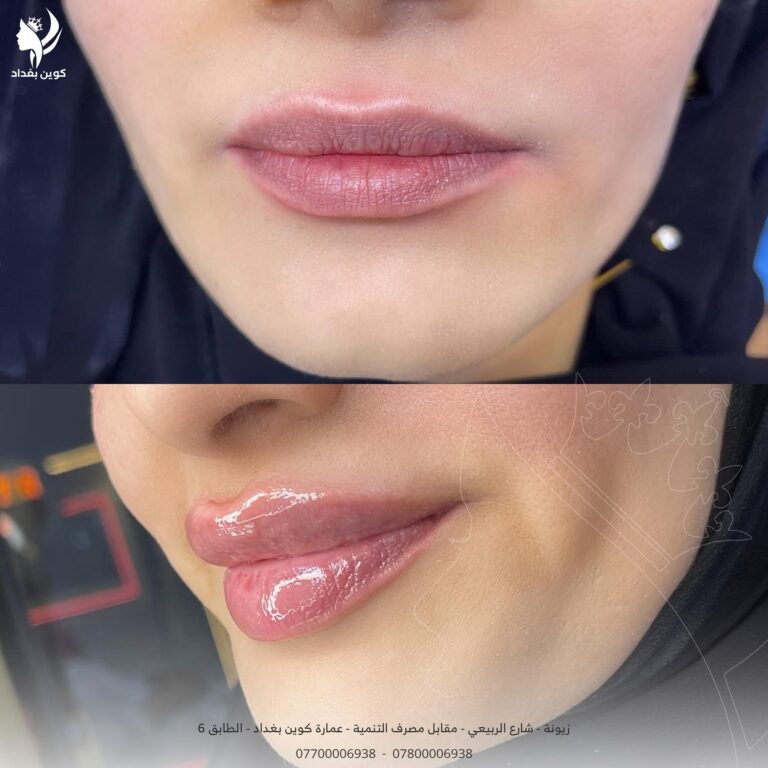 فلر شفاه 2 768x768