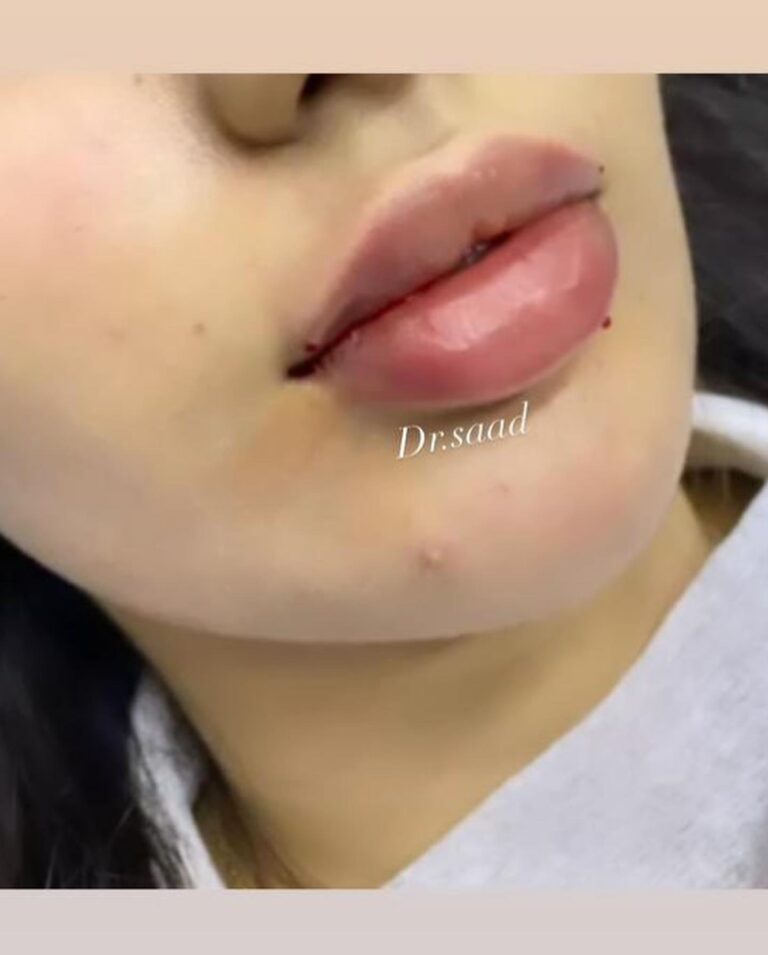 فلر شفاه 21 768x955