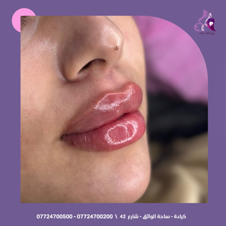 فلر شفاه 22 768x768