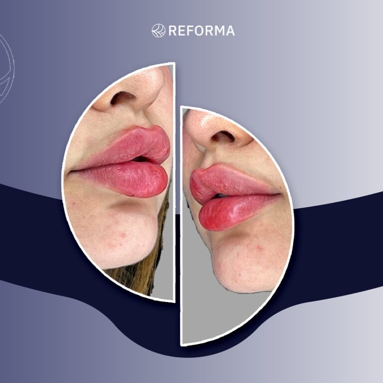 فلر شفاه 23 768x767