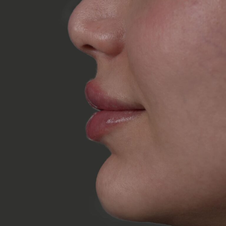 فلر شفاه 3 768x768