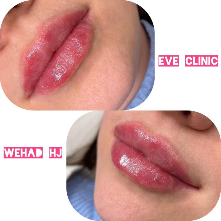 فلر شفاه 4 768x768