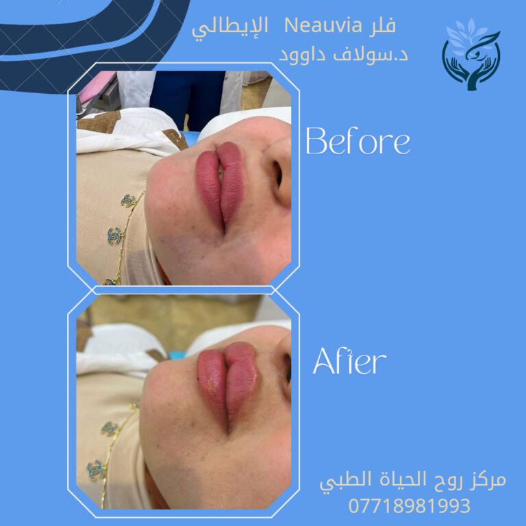 فلر شفاه 5 768x768