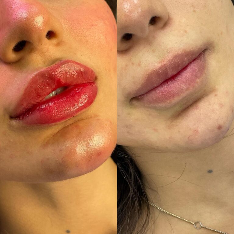 فلر شفاه 6 768x768