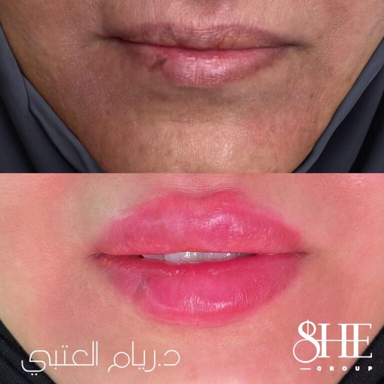 فلر شفاه 7 768x768