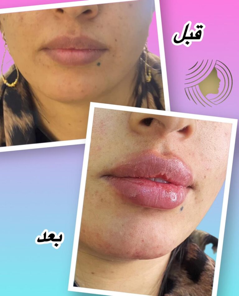 فلر شفاه 768x953