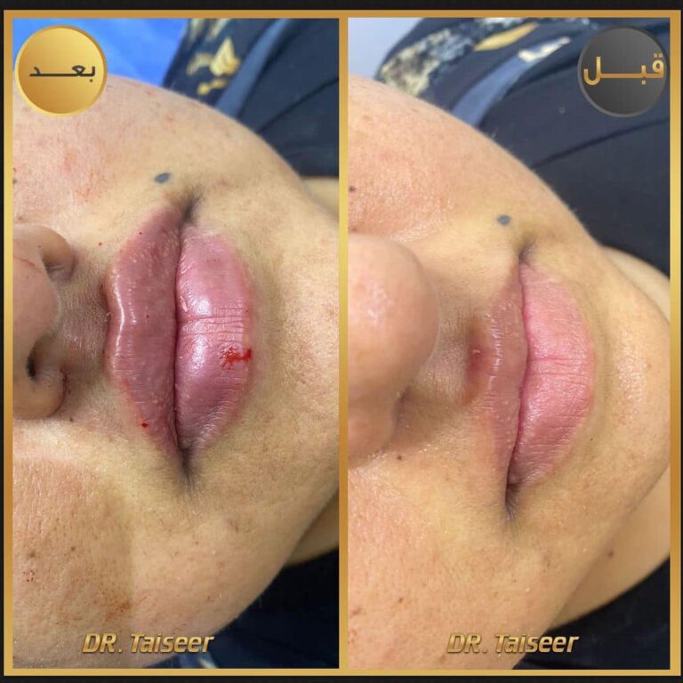 فلر شفاه 8 768x768