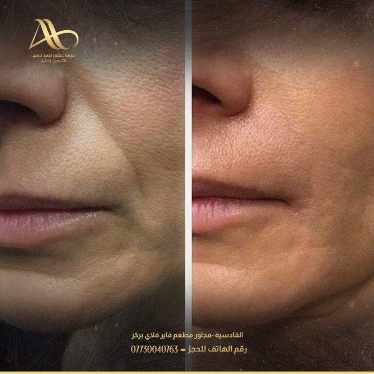 فلر للخطوط الضاحكه 768x768