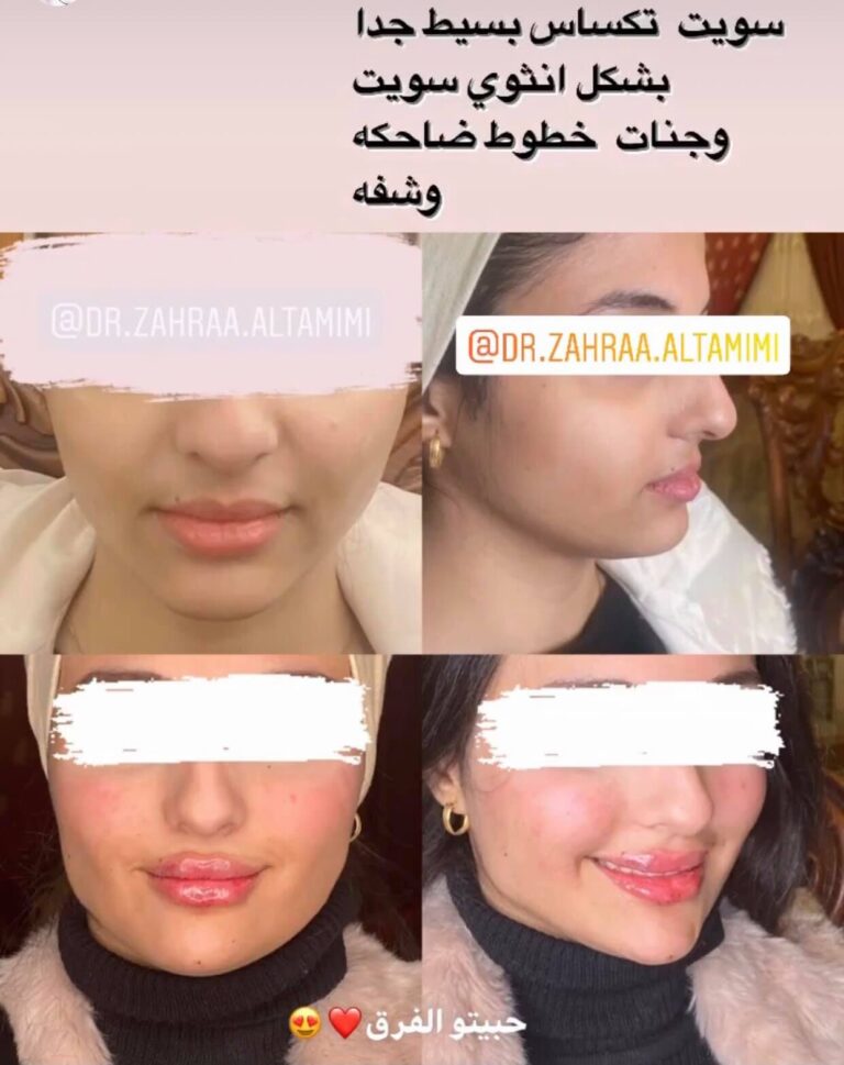 فلر وجه 768x969