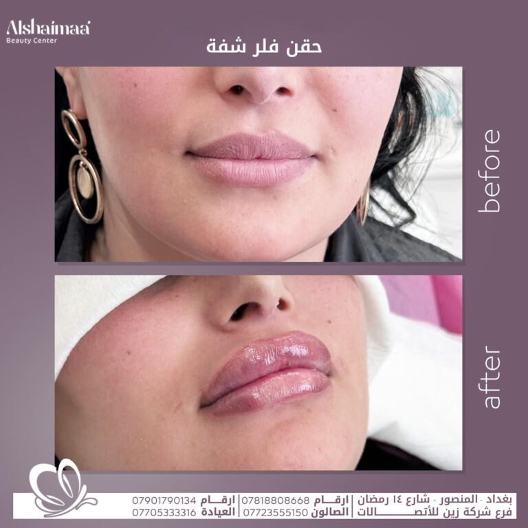 فلير شفاه 1 768x768