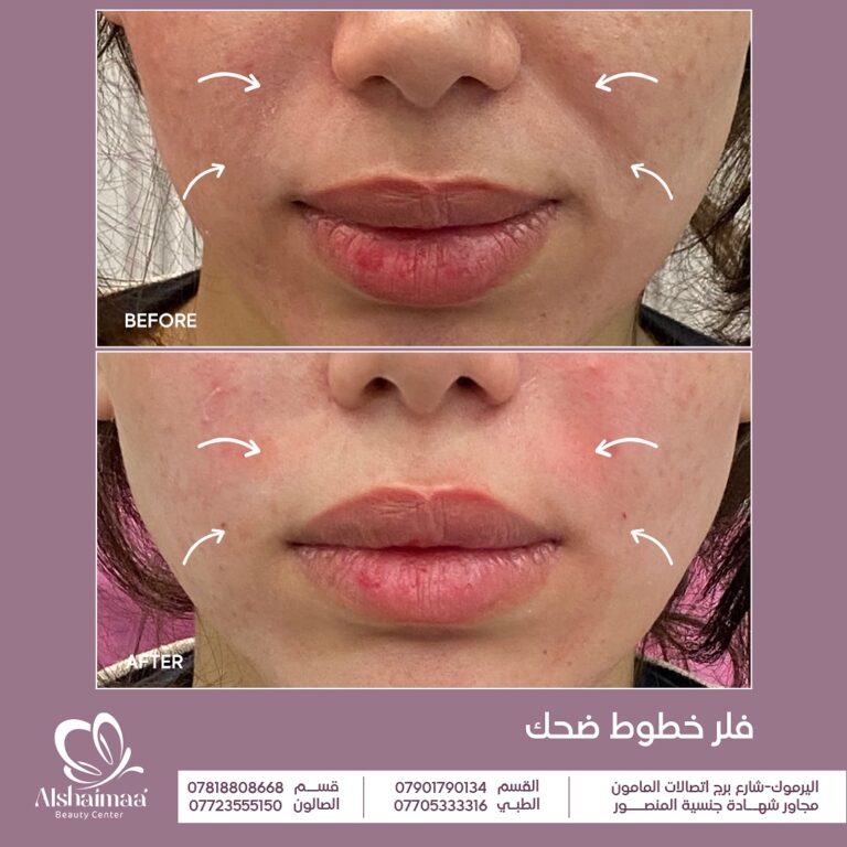 فيلر الخطوط الضاحكة 768x768