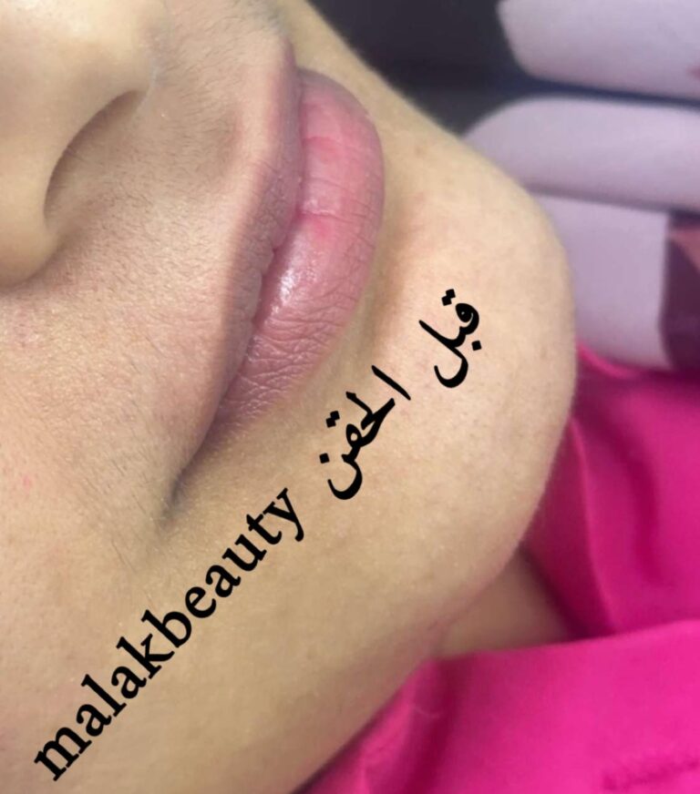 قبل الحقن 768x872