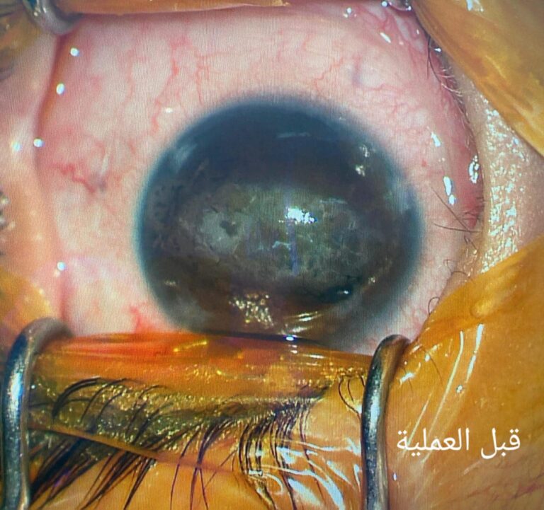 قبل العمليه 768x721